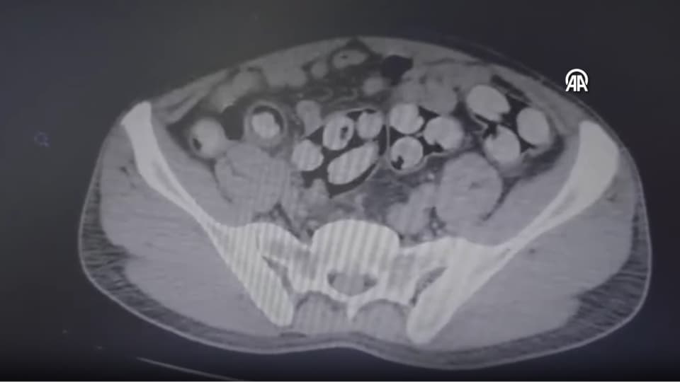 Tam 139 kapsül! Tomografide ortaya çıktı