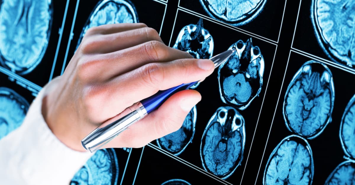 Alzheimer tedavisinde yeni dönem! Antikor tedavisi evde uygulanabilecek