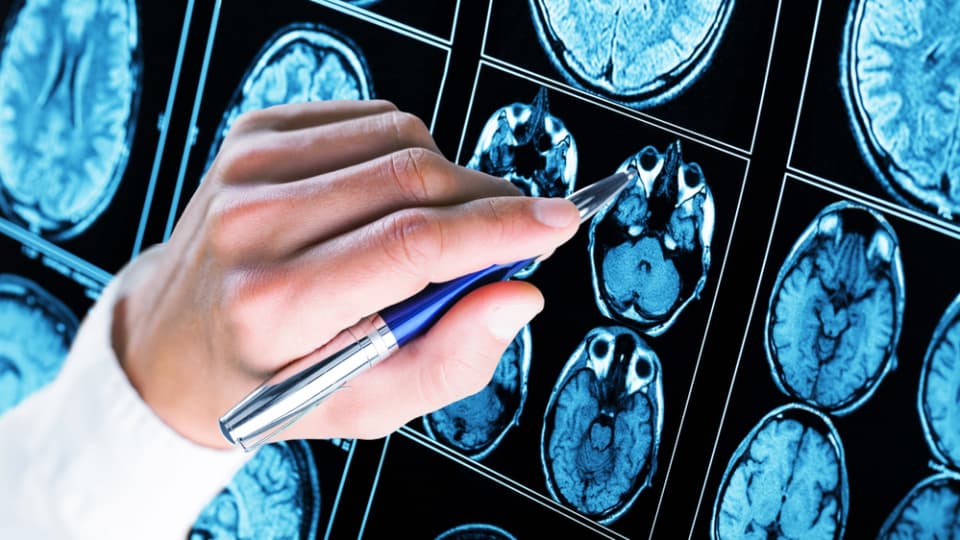 Alzheimer tedavisinde yeni dönem! Antikor tedavisi evde uygulanabilecek