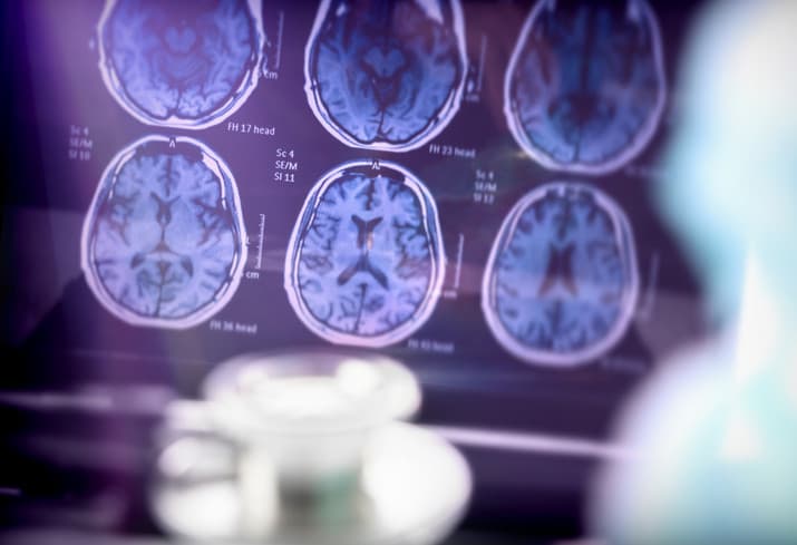 Sinsi hastalık, ilk belirtiden 20 yıl önce başlıyor! Bu hatalar Alzheimer’a zemin hazırlıyor